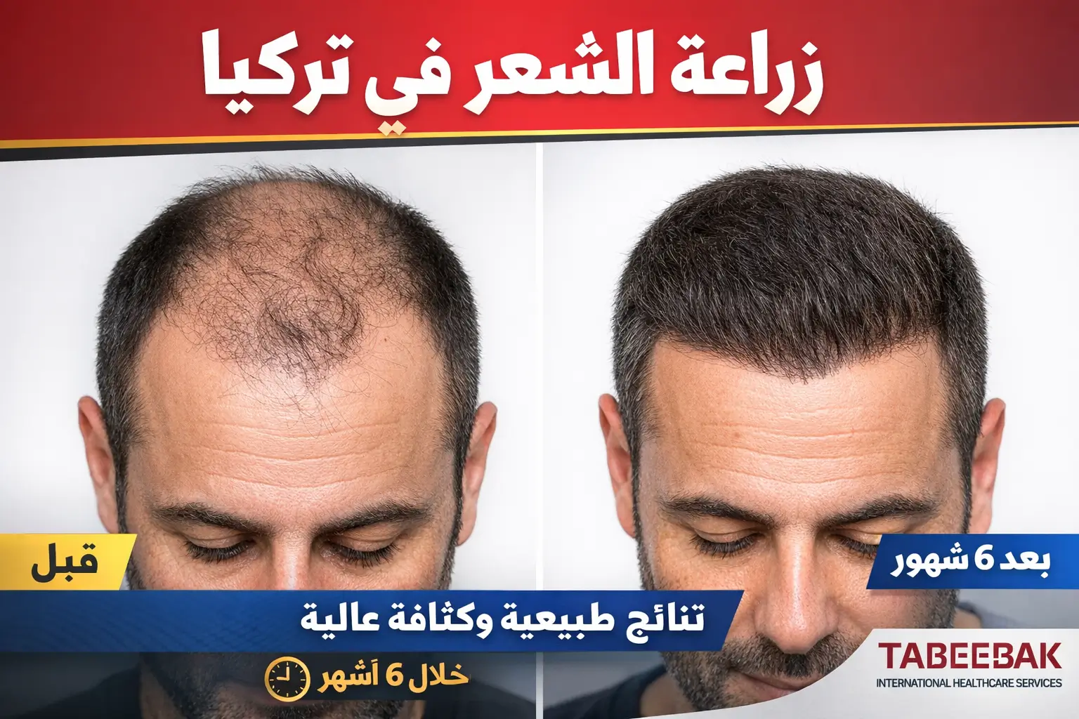 نتائج زراعة الشعر في تركيا قبل وبعد – خط شعر طبيعي وكثافة عالية