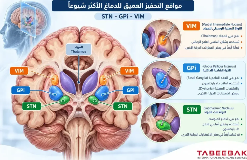 مواقع STN وGPi وVIM المستخدمة في التحفيز العميق للدماغ