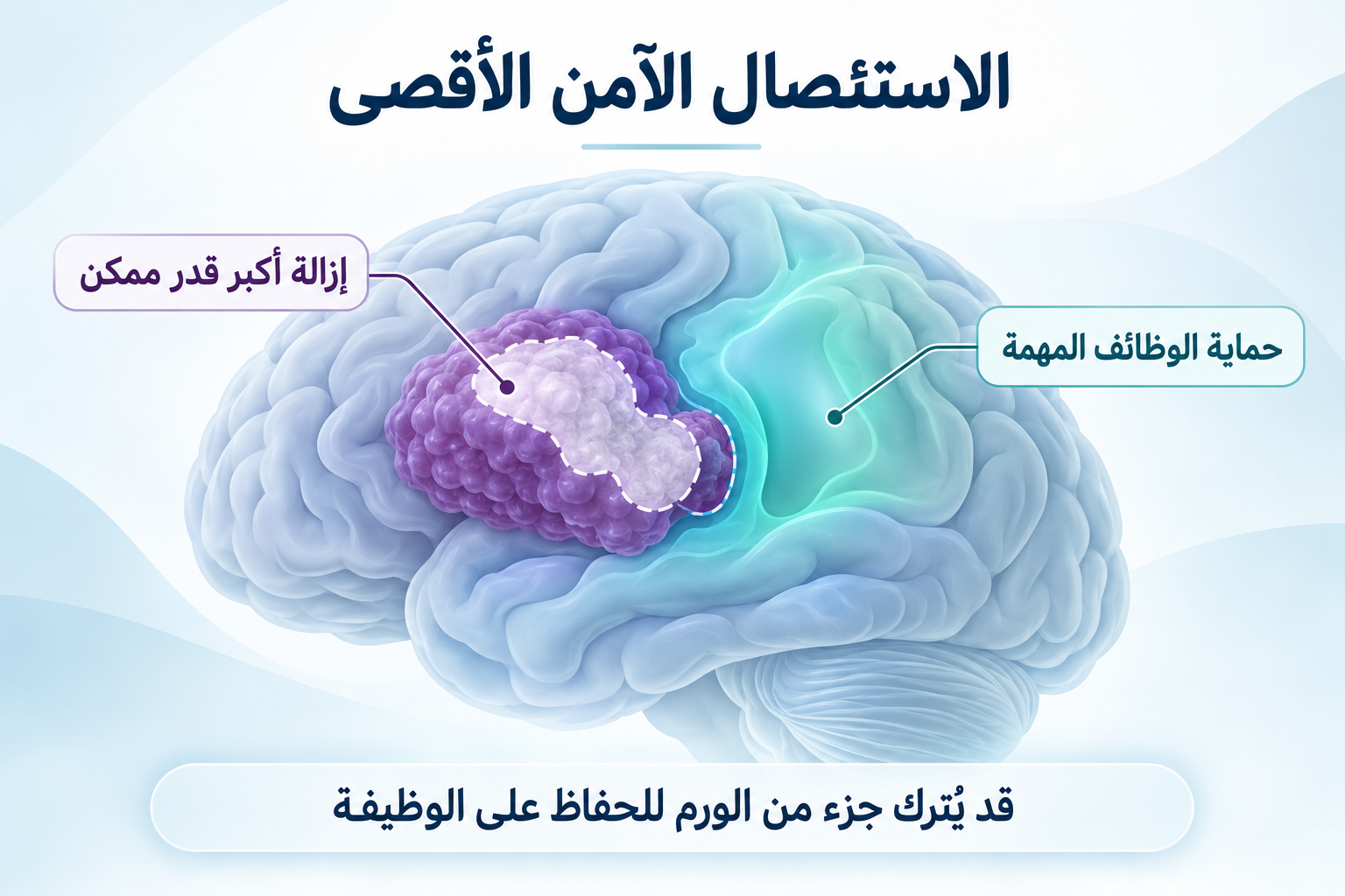 الاستئصال الآمن الأقصى لورم الدماغ مع الحفاظ على الوظائف العصبية